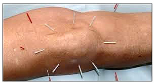Acupuntura en Colmenar Viejo