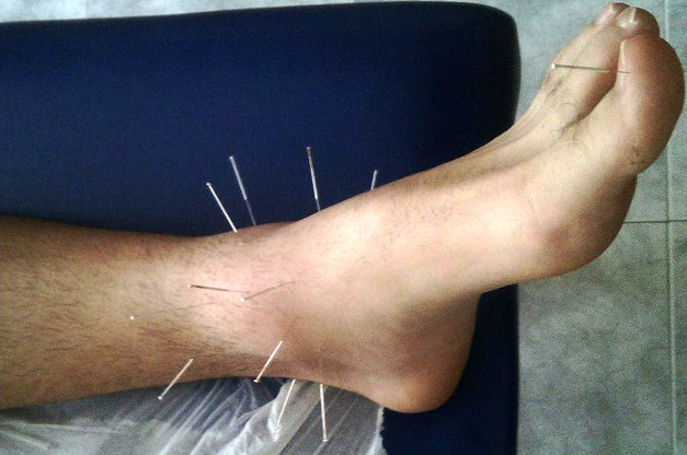 Acupuntura tratamiento dolor