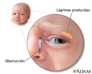 Tratamiento osteopatía obstrucción conducto lacrimal en bebés