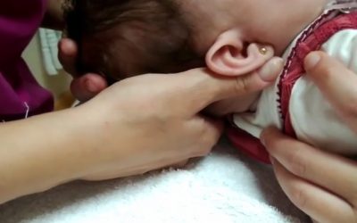 ¿QUÉ ES LA OTITIS MEDIA Y CUALES SON SUS SÍNTOMAS ?
